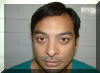After hair transplantation