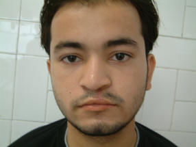 After Cleft Lip Correction