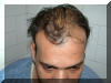 Severe Hair Loss
