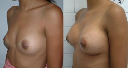 Breast augmentation-260 ml