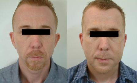 FACIAL PROFILE CORRECTION