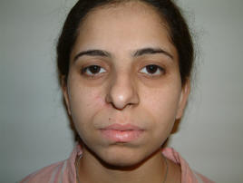Cheek after Tumour Removal